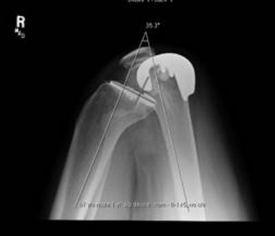 Knee Prostheses:  Bicompartmental:  Smit & Nephew Deuce (Implant 1005)